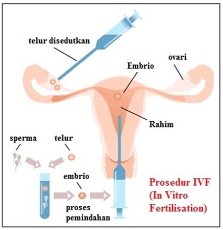 Cara-alternatif-untuk-mengandung-IVF