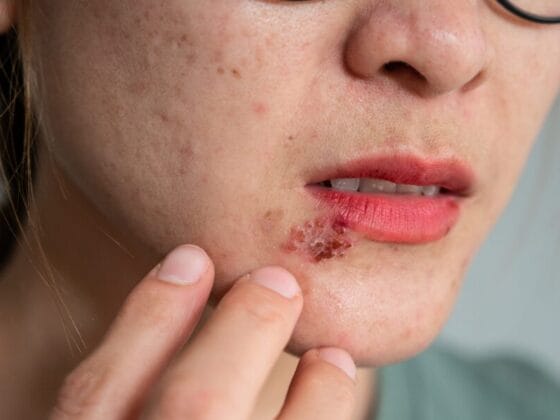 5 Fakta Mengejutkan Tentang Penyakit Herpes